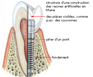 Implants Dentaires