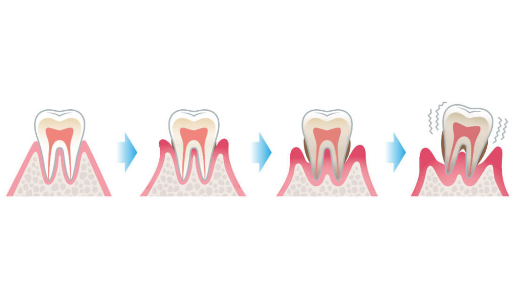 Parodontose Diagnostic