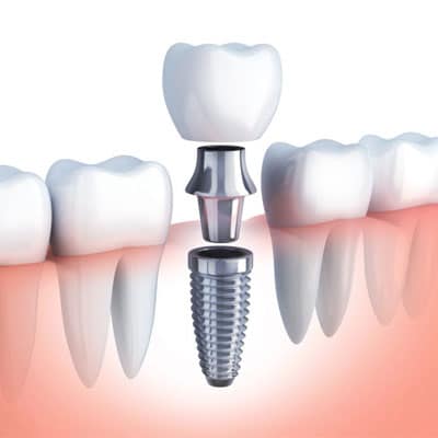 Comment puis-je choisir un bon chirurgien ou une clinique pour me faire poser des implants dentaires en Turquie ? Y a-t-il des certifications ou des accréditations à prendre en compte ?