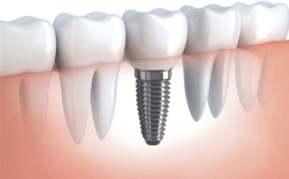 Implant Dentaire – Plan de Traitement