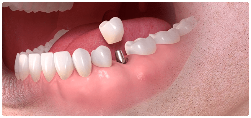 <span lang ="en">Best dental implants in Turkey</span>