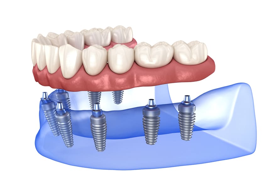 Prix implant dentaire mâchoire complète turquie