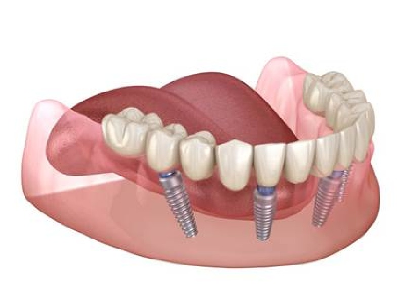 Prix implant dentaire mâchoire complète Turquie forum