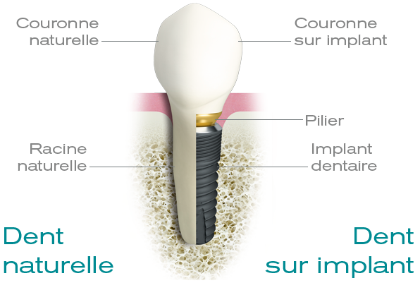 Implant Dentaire Dentego