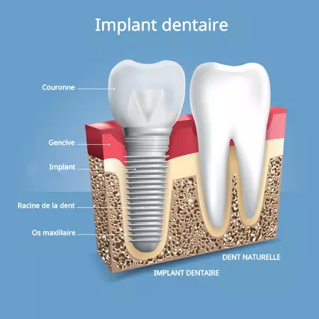 Pose implant dentaire